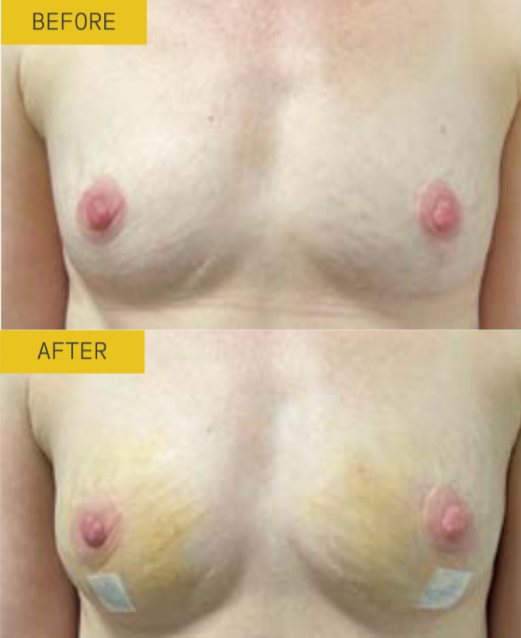 alloclae before and after results alloclae before and after results
