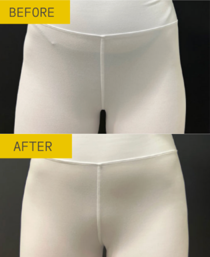 alloclae before and after results alloclae before and after results